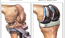 膝关节置换手术视频,从术前准备到术后康复